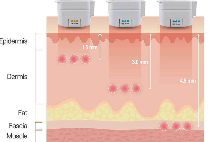 Ultherapy Body