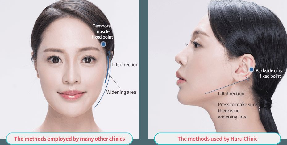 PDO, PLLA, or PCL? What Korean 30-somethings actually book.